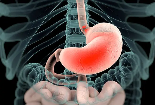 Acid Reflux and Heartburn: Causes, Quick Relief, and Prevention